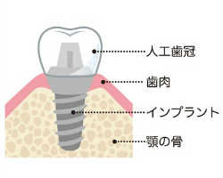 インプラントの図